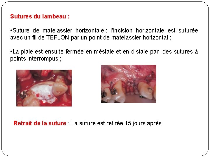 Sutures du lambeau : • Suture de matelassier horizontale : l’incision horizontale est suturée