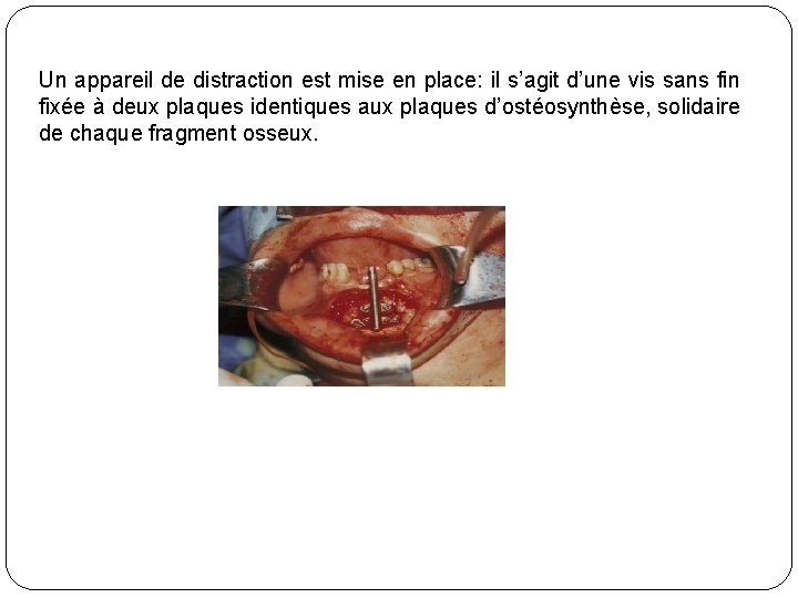 Un appareil de distraction est mise en place: il s’agit d’une vis sans fin