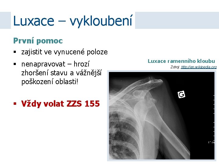 Luxace – vykloubení První pomoc zajistit ve vynucené poloze nenapravovat – hrozí zhoršení stavu