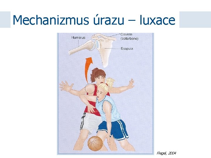 Mechanizmus úrazu – luxace Flegel, 2004 