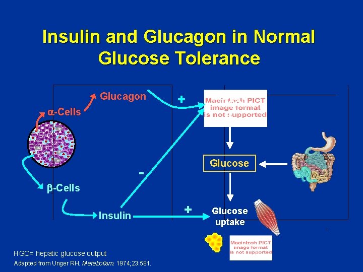 Insulin and Glucagon in Normal Glucose Tolerance Glucagon -Cells + HGO Glucose -Cells Insulin
