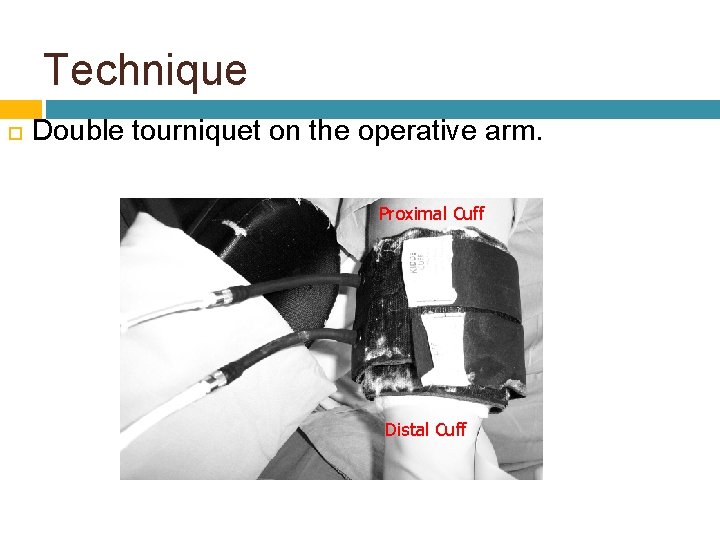 Technique Double tourniquet on the operative arm. Proximal Cuff Distal Cuff 