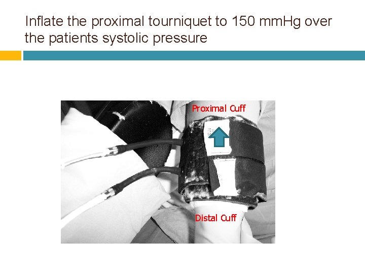 Inflate the proximal tourniquet to 150 mm. Hg over the patients systolic pressure Proximal