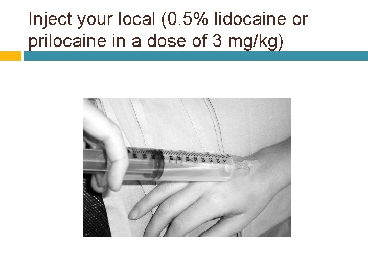 Inject your local (0. 5% lidocaine or prilocaine in a dose of 3 mg/kg)