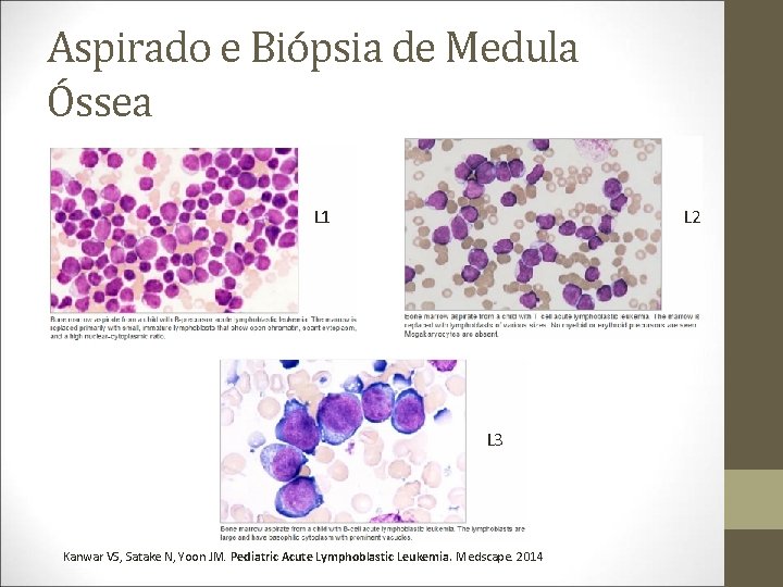 Aspirado e Biópsia de Medula Óssea L 1 L 2 L 3 Kanwar VS,