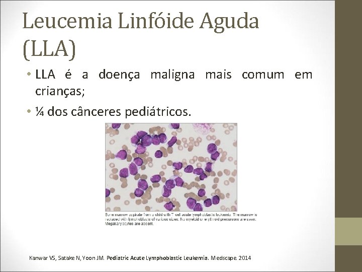 Leucemia Linfóide Aguda (LLA) • LLA é a doença maligna mais comum em crianças;