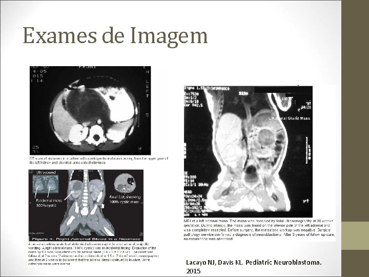 Exames de Imagem Lacayo NJ, Davis KL. Pediatric Neuroblastoma. 2015 