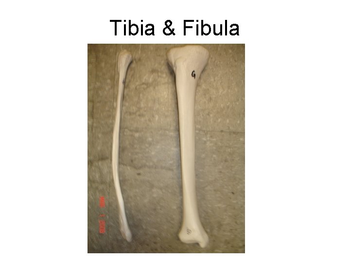 Tibia & Fibula 