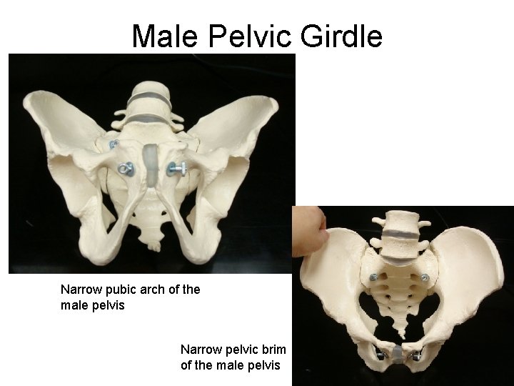 Male Pelvic Girdle Narrow pubic arch of the male pelvis Narrow pelvic brim of