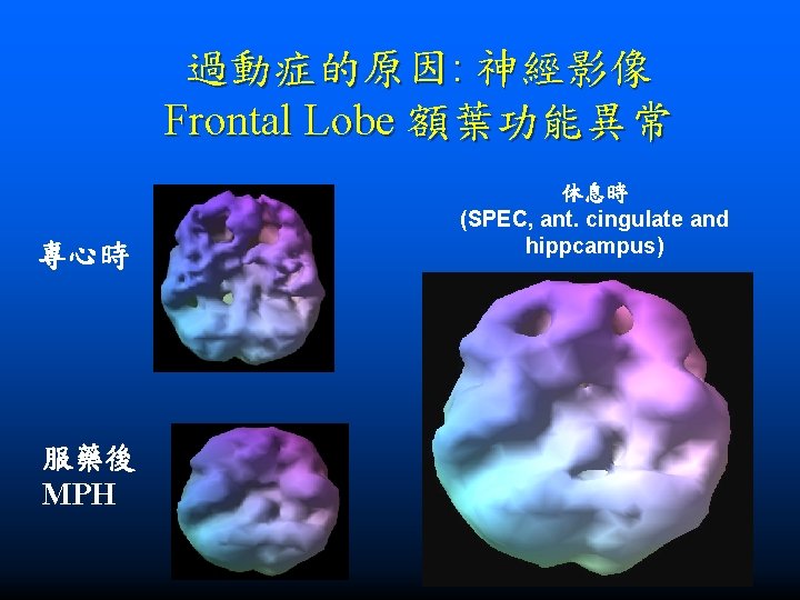 過動症的原因: 神經影像 Frontal Lobe 額葉功能異常 專心時 服藥後 MPH 休息時 (SPEC, ant. cingulate and hippcampus)