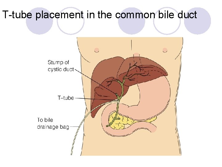 T-tube placement in the common bile duct 