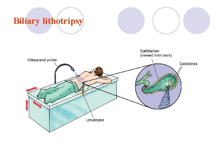 Biliary lithotripsy 