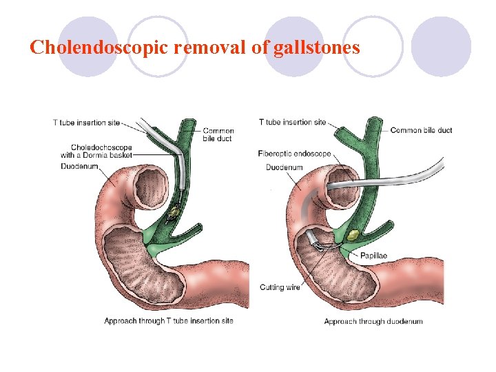 Cholendoscopic removal of gallstones 