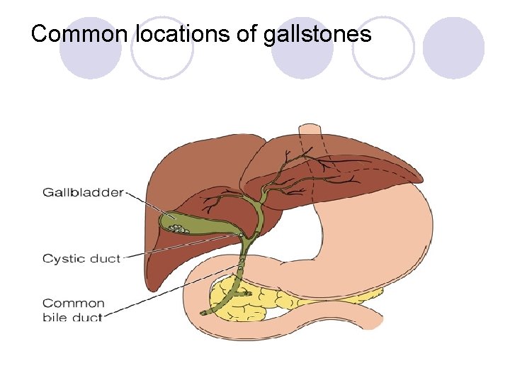 Common locations of gallstones 