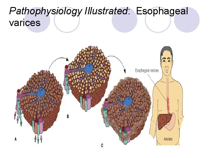 Pathophysiology Illustrated: Esophageal varices 