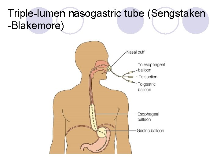 Triple-lumen nasogastric tube (Sengstaken -Blakemore) 