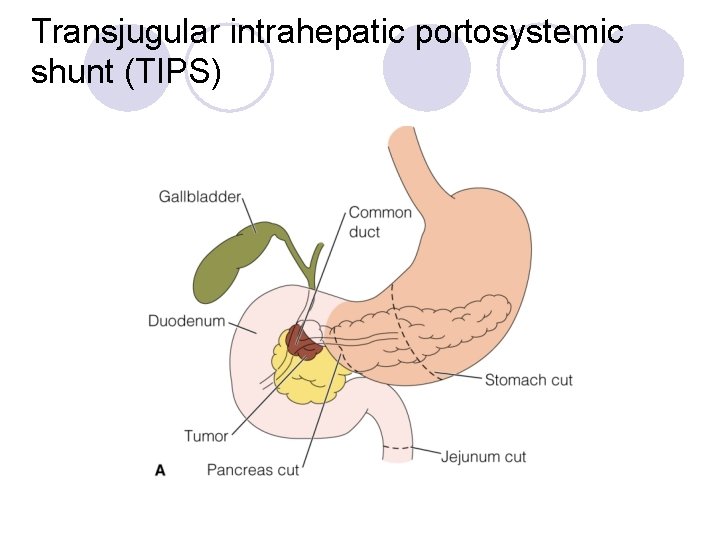 Transjugular intrahepatic portosystemic shunt (TIPS) 