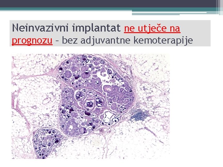 Neinvazivni implantat ne utječe na prognozu – bez adjuvantne kemoterapije 