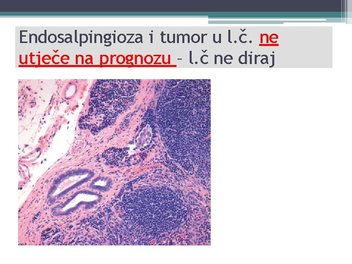 Endosalpingioza i tumor u l. č. ne utječe na prognozu – l. č ne