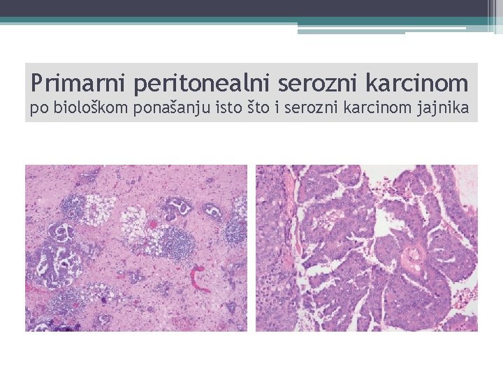 Primarni peritonealni serozni karcinom po biološkom ponašanju isto što i serozni karcinom jajnika 