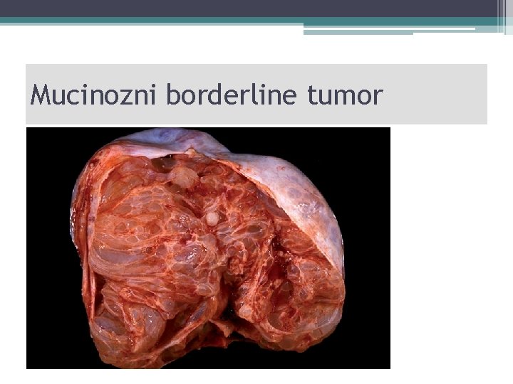 Mucinozni borderline tumor 