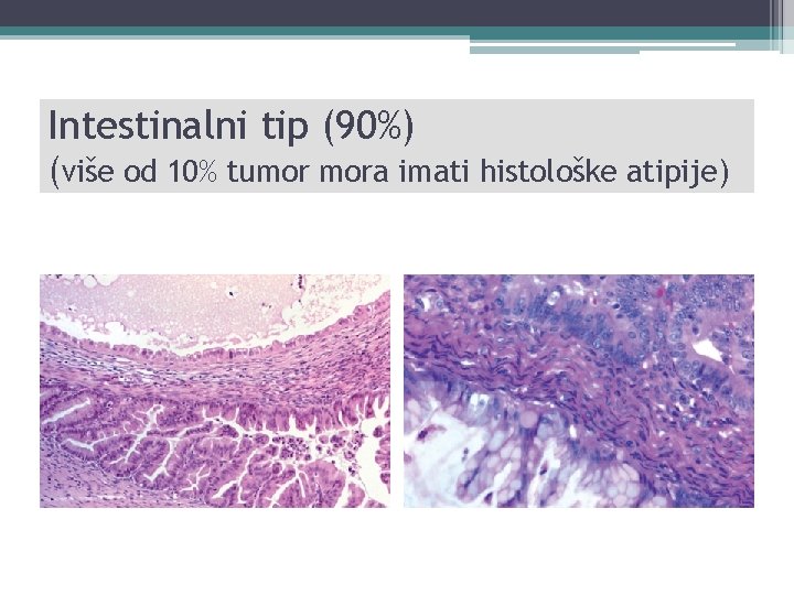 Intestinalni tip (90%) (više od 10% tumor mora imati histološke atipije) 