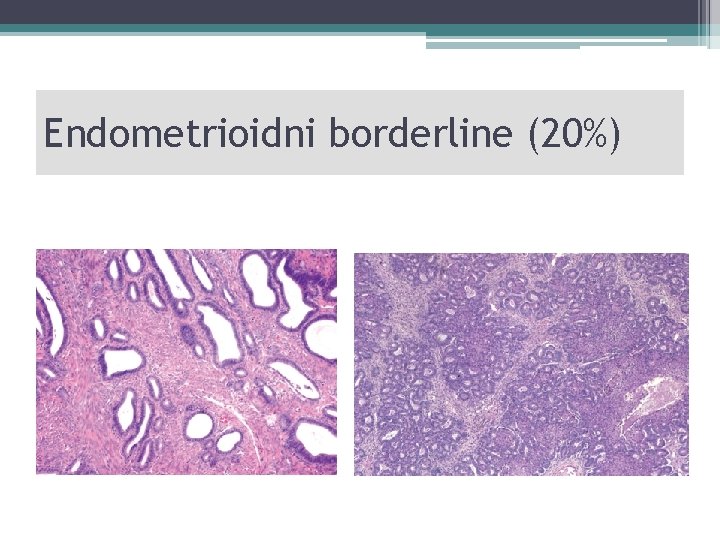 Endometrioidni borderline (20%) 
