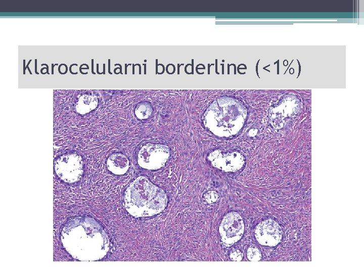 Klarocelularni borderline (<1%) 