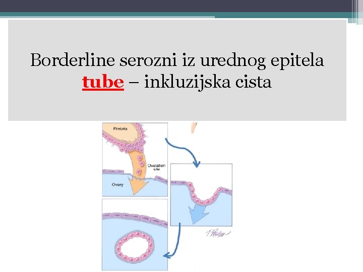 Borderline serozni iz urednog epitela tube – inkluzijska cista 