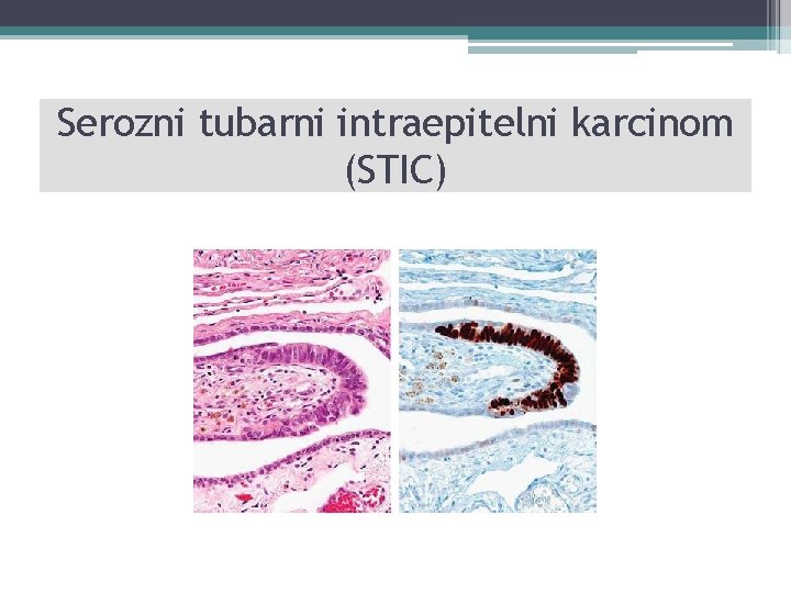 Serozni tubarni intraepitelni karcinom (STIC) 