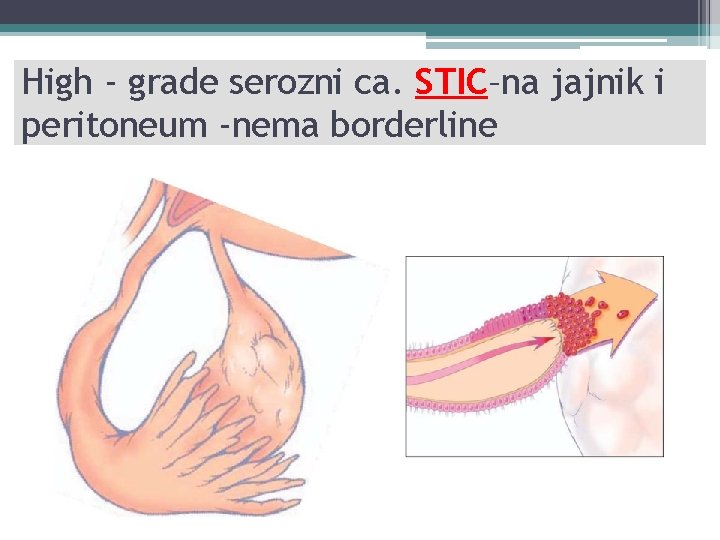 High - grade serozni ca. STIC–na jajnik i peritoneum -nema borderline 