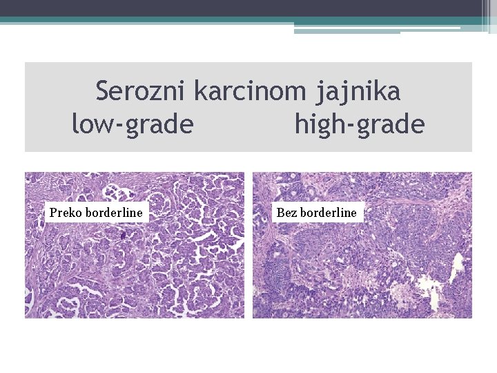 Serozni karcinom jajnika low-grade high-grade Preko borderline Bez borderline 
