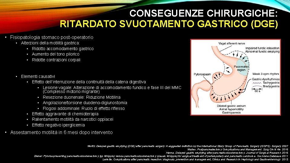 CONSEGUENZE CHIRURGICHE: RITARDATO SVUOTAMENTO GASTRICO (DGE) • Fisiopatologia stomaco post-operatorio • Alterzioni della motilità