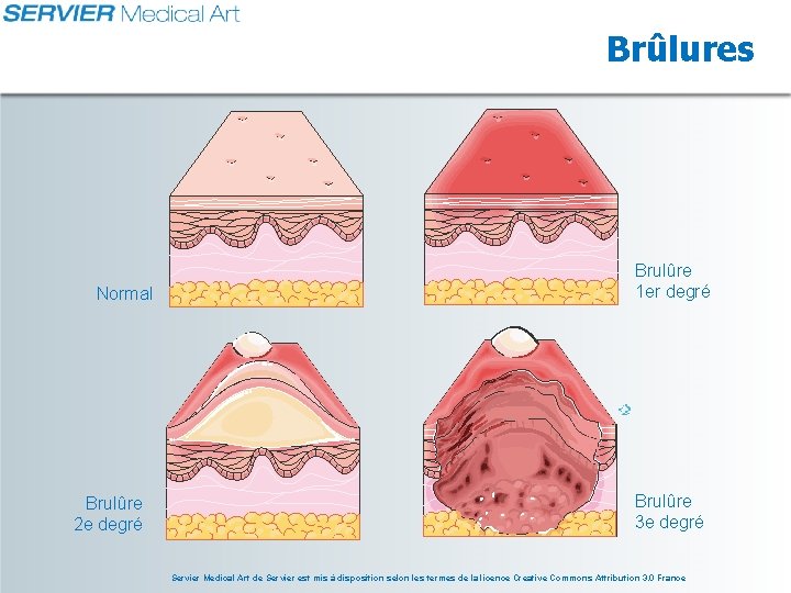 Brûlures Normal Brulûre 2 e degré Brulûre 1 er degré Brulûre 3 e degré