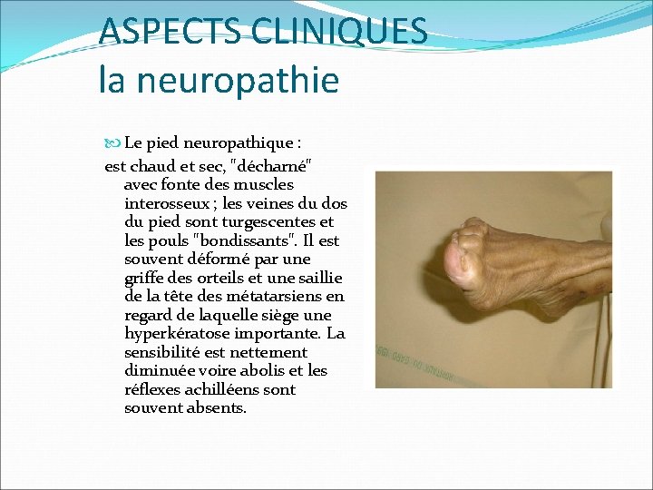 ASPECTS CLINIQUES la neuropathie Le pied neuropathique : est chaud et sec, "décharné" avec