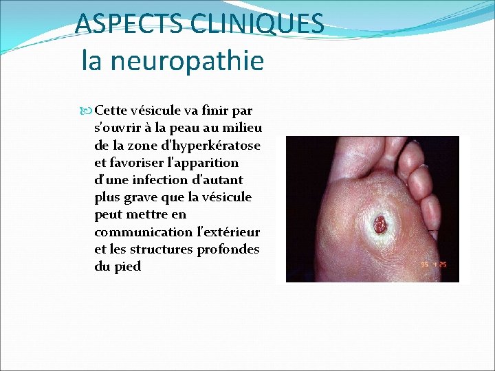 ASPECTS CLINIQUES la neuropathie Cette vésicule va finir par s'ouvrir à la peau au