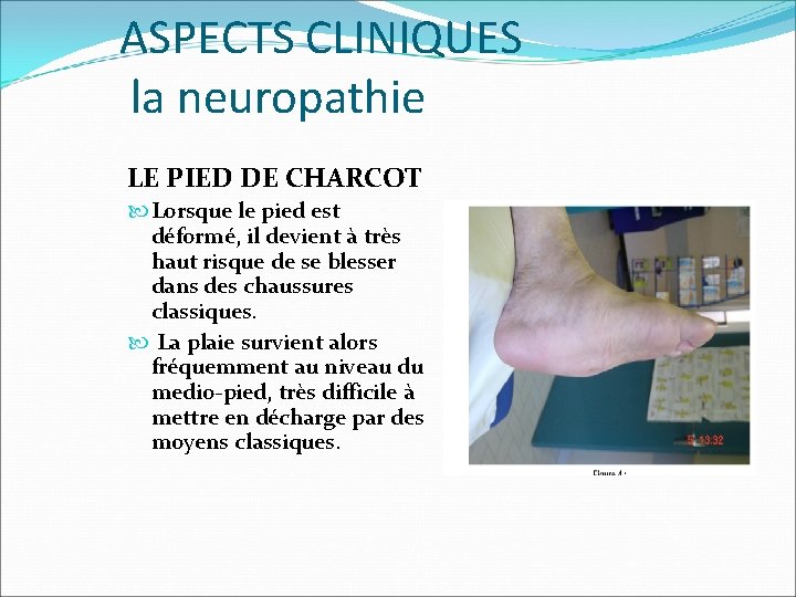 ASPECTS CLINIQUES la neuropathie LE PIED DE CHARCOT Lorsque le pied est déformé, il