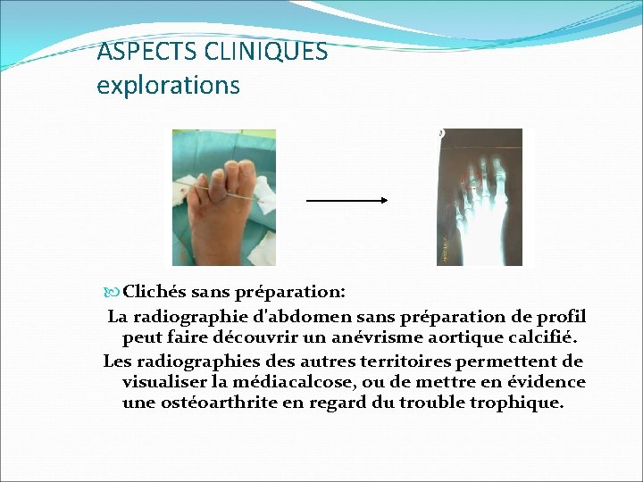 ASPECTS CLINIQUES explorations Clichés sans préparation: La radiographie d'abdomen sans préparation de profil peut