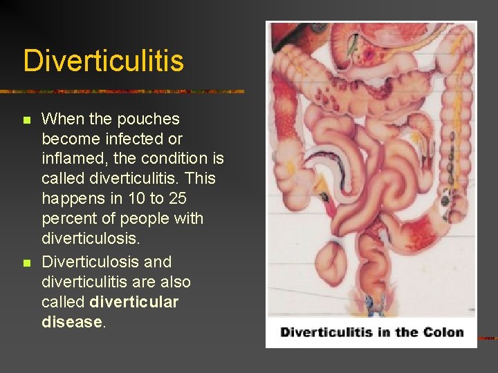 Diverticulitis n n When the pouches become infected or inflamed, the condition is called