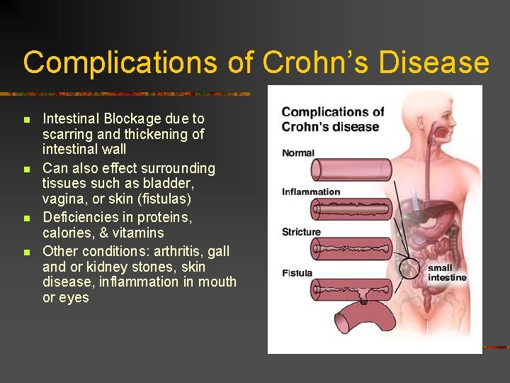 Complications of Crohn’s Disease n n Intestinal Blockage due to scarring and thickening of