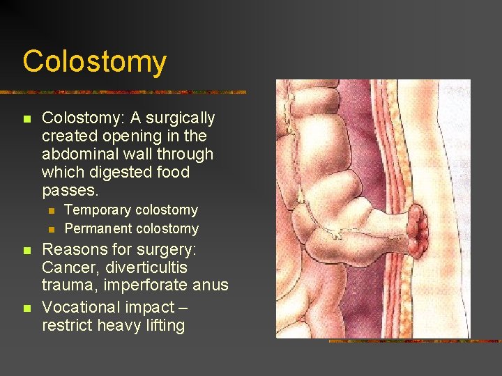 Colostomy n Colostomy: A surgically created opening in the abdominal wall through which digested