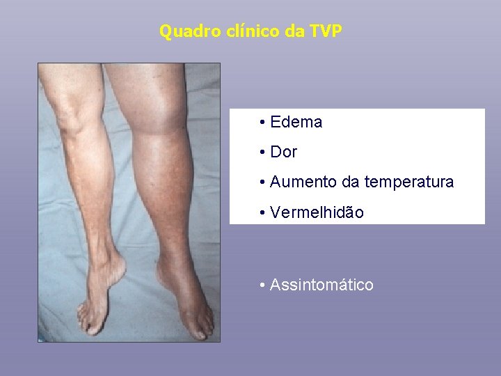 Quadro clínico da TVP • Edema • Dor • Aumento da temperatura • Vermelhidão