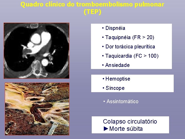 Quadro clínico do tromboembolismo pulmonar (TEP) • Dispnéia • Taquipnéia (FR > 20) •