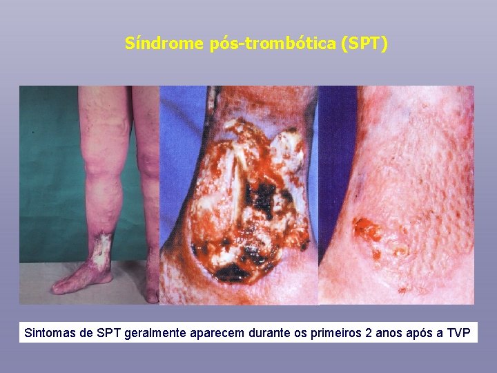 Síndrome pós-trombótica (SPT) Sintomas de SPT geralmente aparecem durante os primeiros 2 anos após