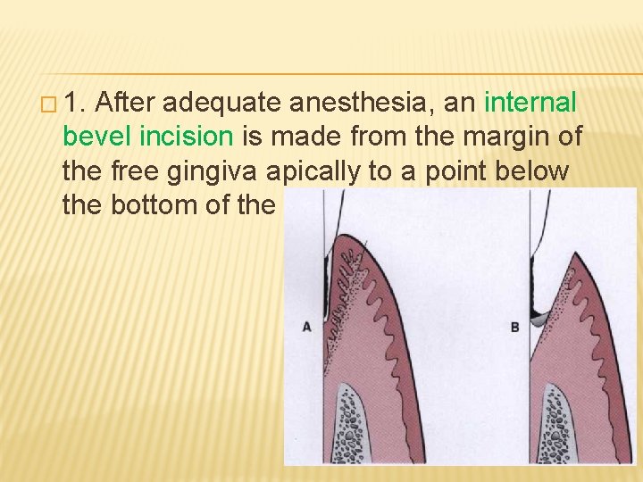 � 1. After adequate anesthesia, an internal bevel incision is made from the margin