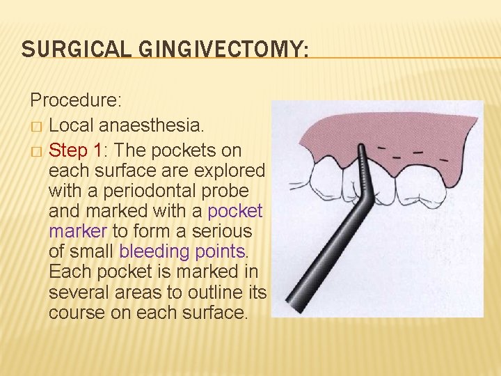 SURGICAL GINGIVECTOMY: Procedure: � Local anaesthesia. � Step 1: The pockets on each surface