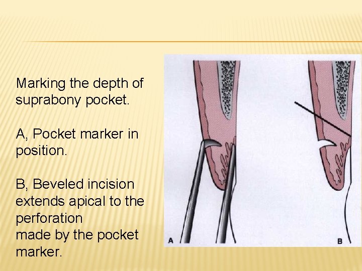 Marking the depth of suprabony pocket. A, Pocket marker in position. B, Beveled incision