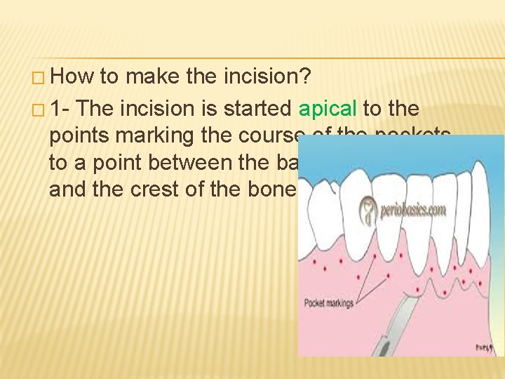 � How to make the incision? � 1 - The incision is started apical