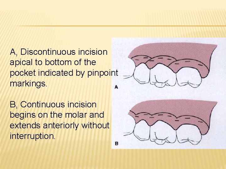 A, Discontinuous incision apical to bottom of the pocket indicated by pinpoint markings. B,