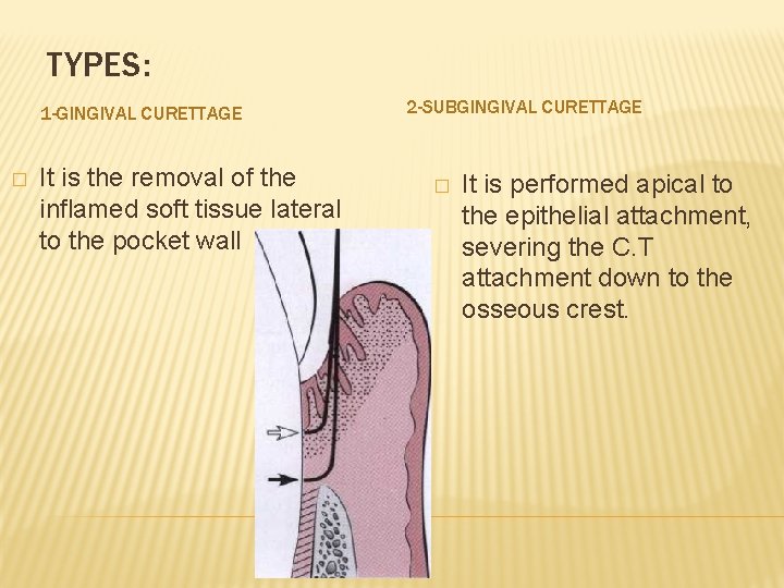 TYPES: 1 -GINGIVAL CURETTAGE � It is the removal of the inflamed soft tissue